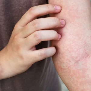 The Common Reasons Sweat can Cause Itching (Heat Rash)