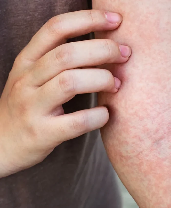 The Common Reasons Sweat can Cause Itching (Heat Rash)